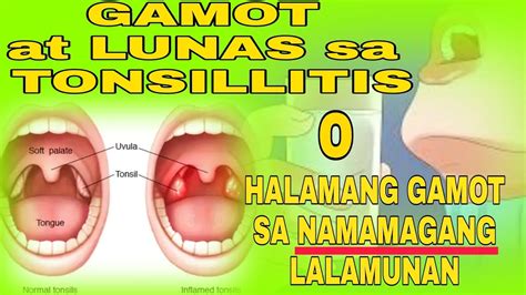 Mga gamot sa masakit na tonsil o lalamunan (tonsillitis).